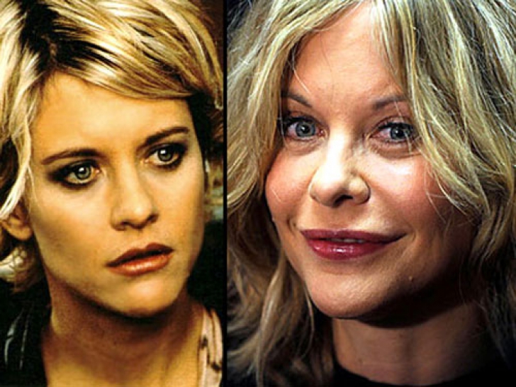 meg-ryan-before-and-after-plastic-surgery-chirurgia-estetica